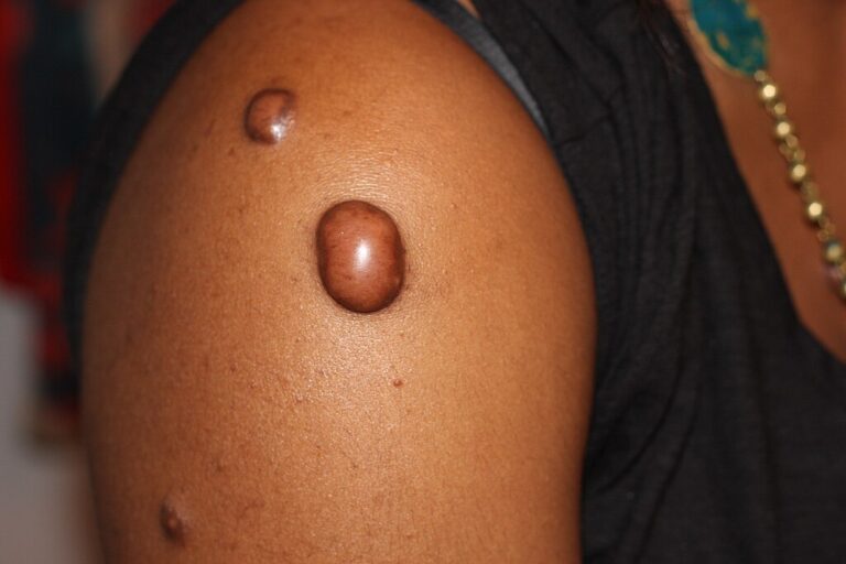 Keloid Nodular Keloid Tumor